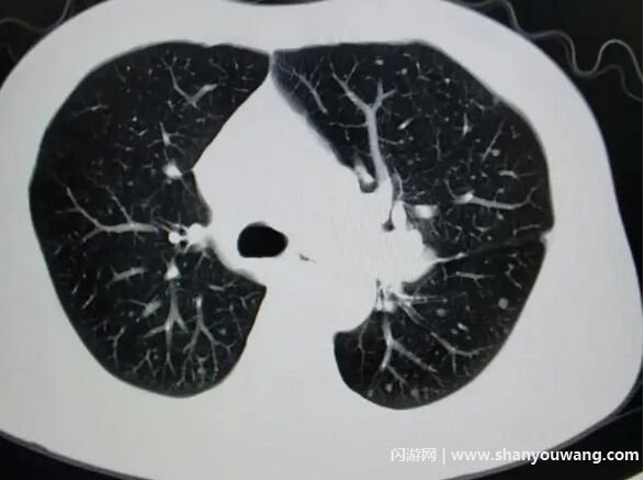为什么CT很多人有肺部小结节 肺结节不等于肺癌八成是良性